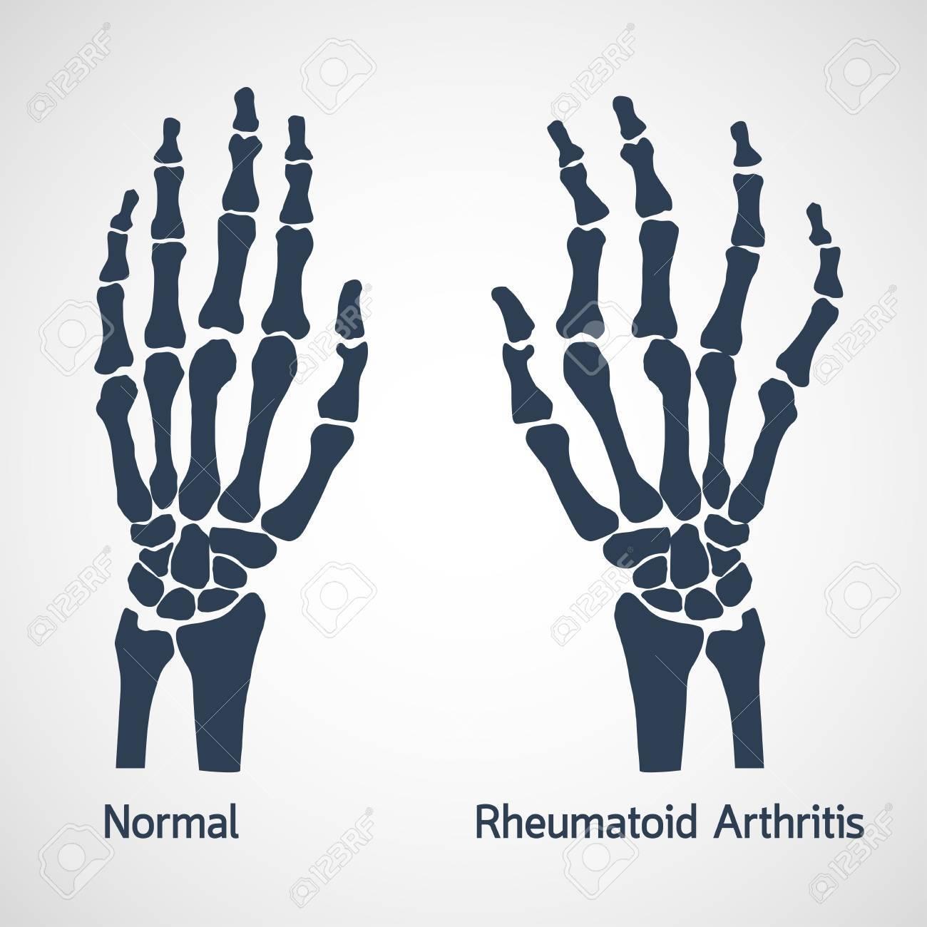 Arthrite arthrose